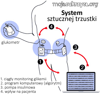 Sztuczna trzustka pokonaa w tecie pomp insulinow. Jest nadzieja.